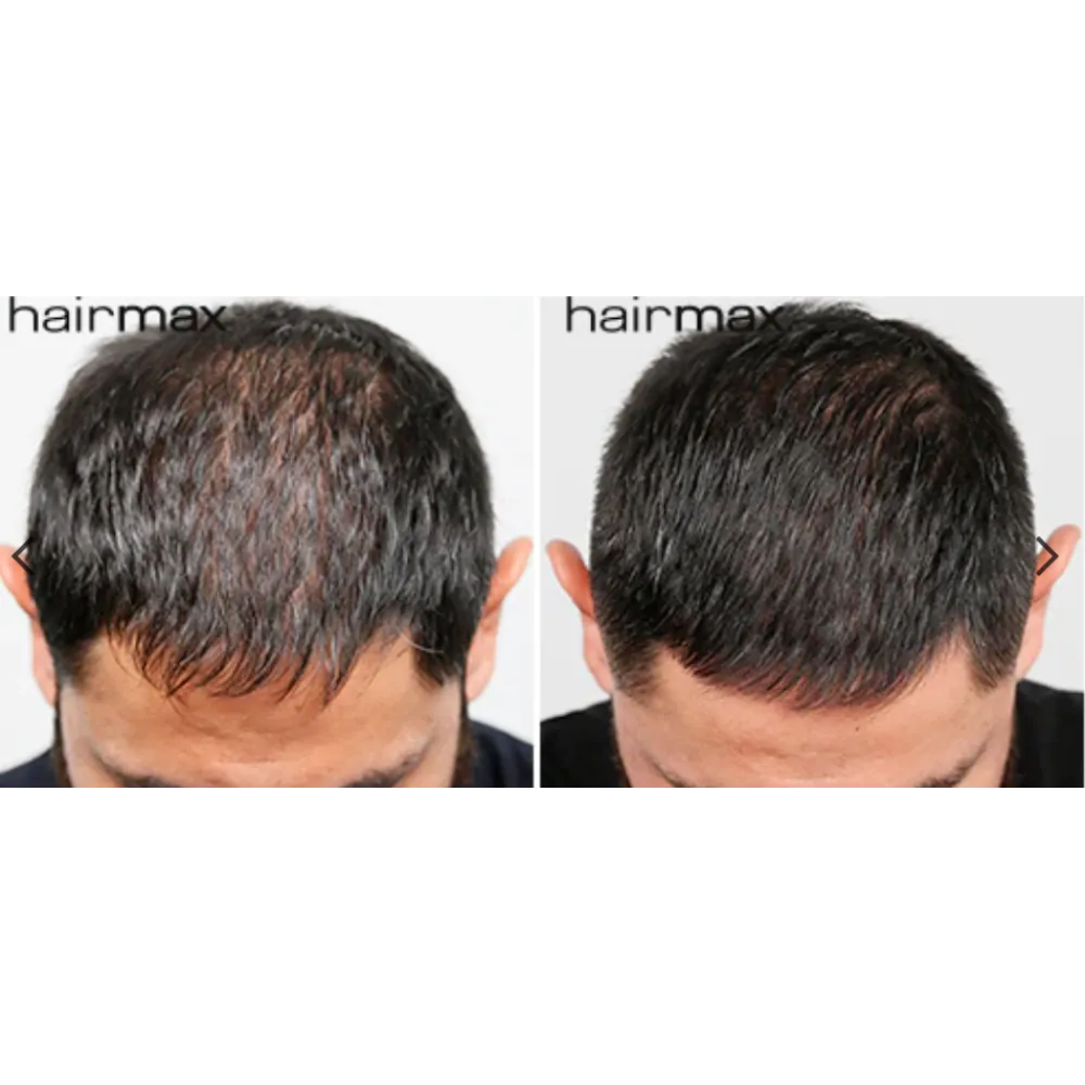 HairMax LaserBand 82 - ComfortFlex Лазерный обруч