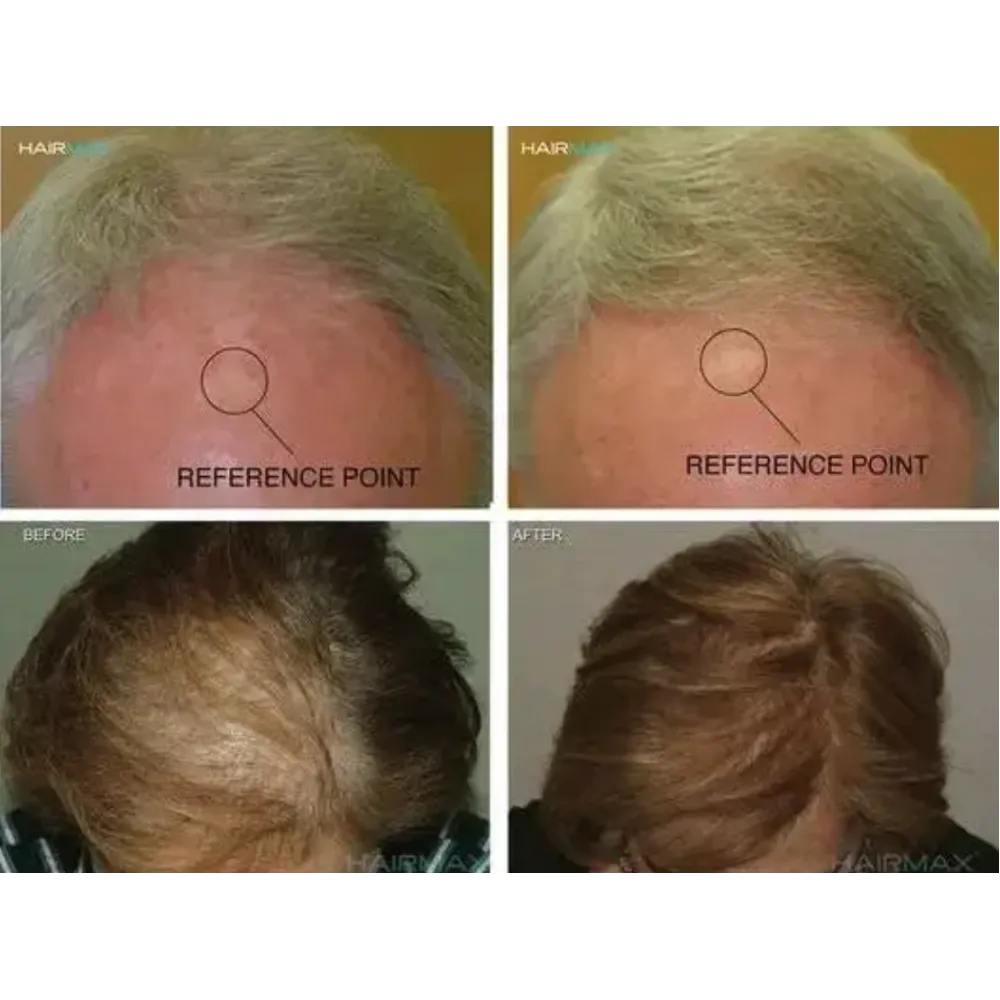 HairMax Лазерная кепка HairMax Laser 272 PowerFlex