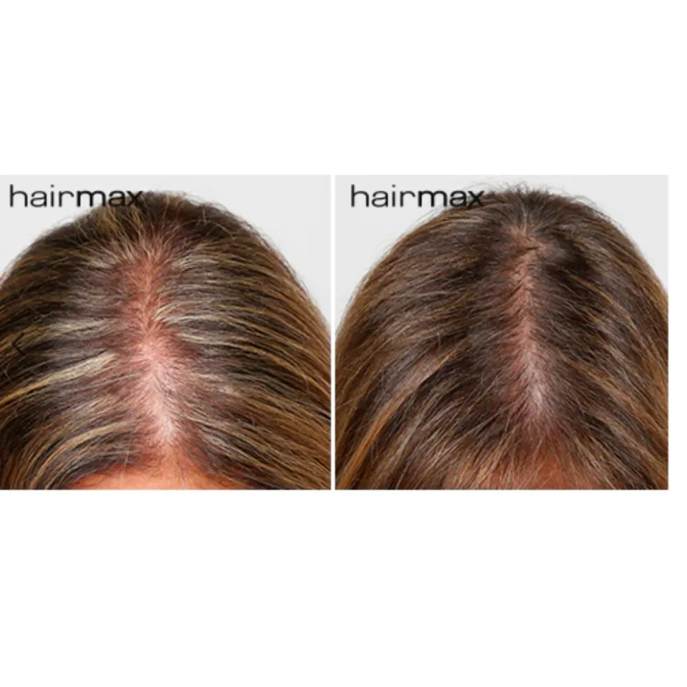 HairMax LaserBand 82 - ComfortFlex Лазерный обруч